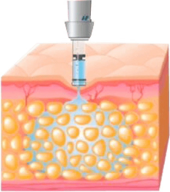 Bezjehlový aplikátor